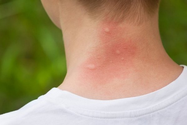 Rệp: Dấu hiệu của sự xâm nhiễm và cách thoát khỏi rệp Rệp: Dấu hiệu của sự xâm nhiễm và cách thoát khỏi rệp