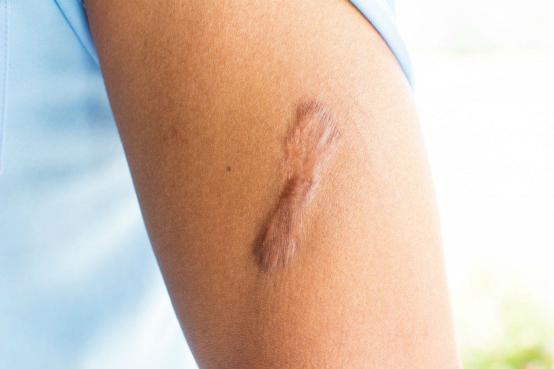 Keloids and hypertrophic scars What you need to know Vinmec