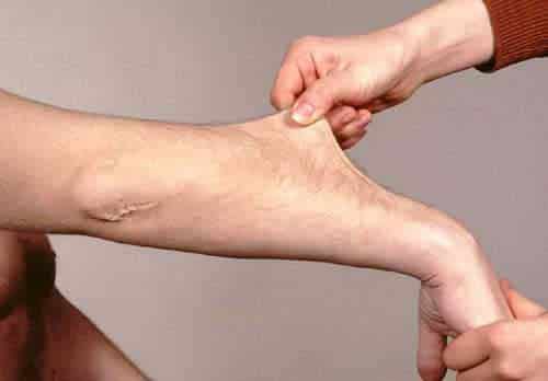 Sự lỏng lẻo dây chằng ở đầu gối, vai, mắt cá chân, cổ Sự lỏng lẻo dây chằng ở đầu gối, vai, mắt cá chân, cổ