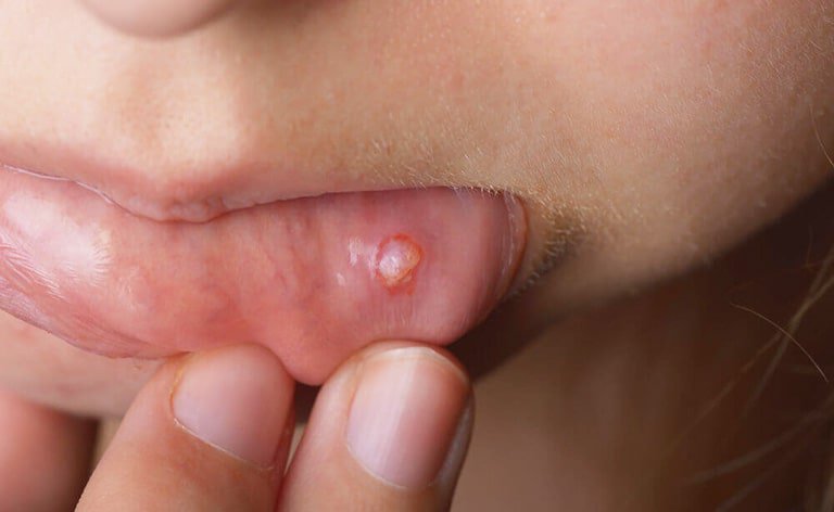 Trẻ nổi mụn nước ở môi dùng Acyclovir được không?