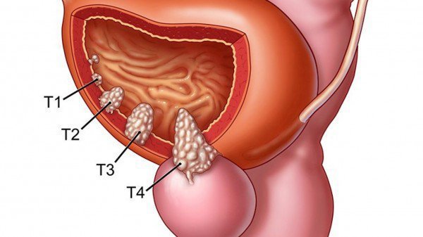Ung thư bàng quang giai đoạn đầu điều trị như thế nào?
