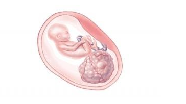 U quái vùng cùng cụt thai nhi - Sacrococcygeal teratoma (SCT) U quái vùng cùng cụt thai nhi - Sacrococcygeal teratoma (SCT)