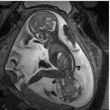 U quái vùng cùng cụt thai nhi - Sacrococcygeal teratoma (SCT) U quái vùng cùng cụt thai nhi - Sacrococcygeal teratoma (SCT)