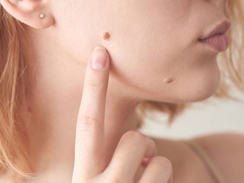 retinoid hỗ trợ điều trị mụn cóc