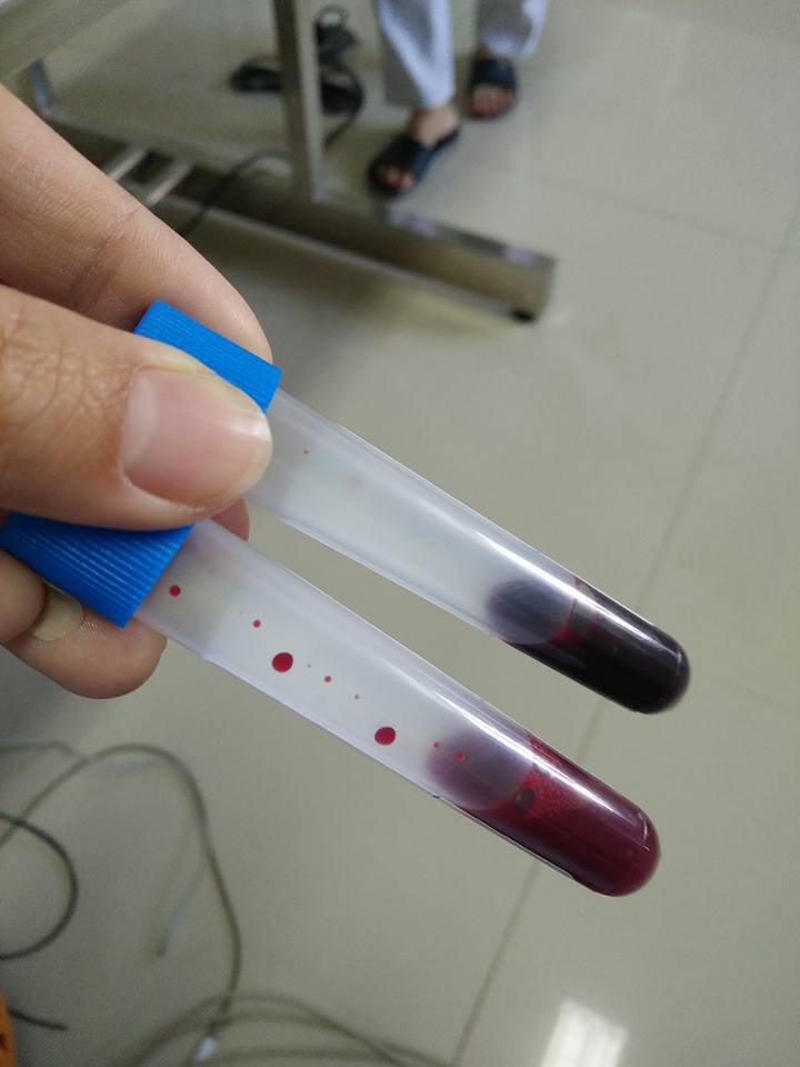 Cholinesterase blood test Vinmec