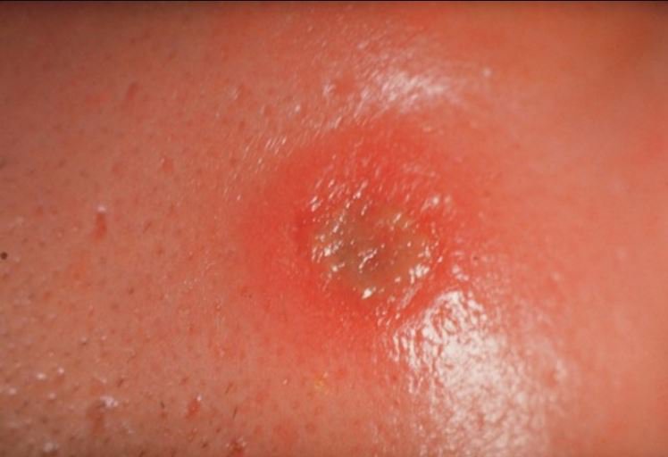 Xét nghiệm Syphilis sàng lọc bệnh giang mai Xét nghiệm Syphilis sàng lọc bệnh giang mai