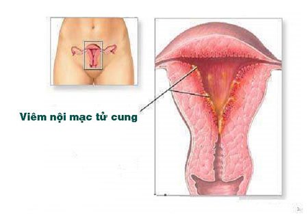 Viêm nội mạc tử cung