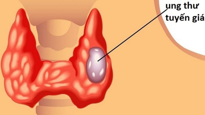 Sau khi cắt bỏ cả 2 thuỳ giáp điều trị tiếp theo thế nào?