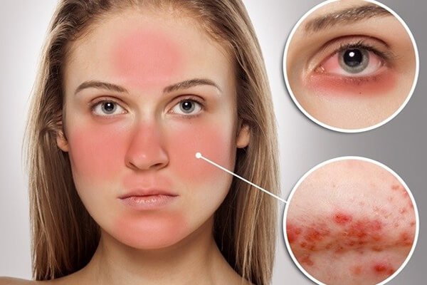 Quy trình xét nghiệm kháng thể kháng nhân ANA Quy trình xét nghiệm kháng thể kháng nhân ANA