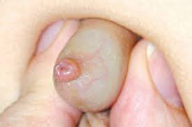 Viêm bao quy đầu ở trẻ em