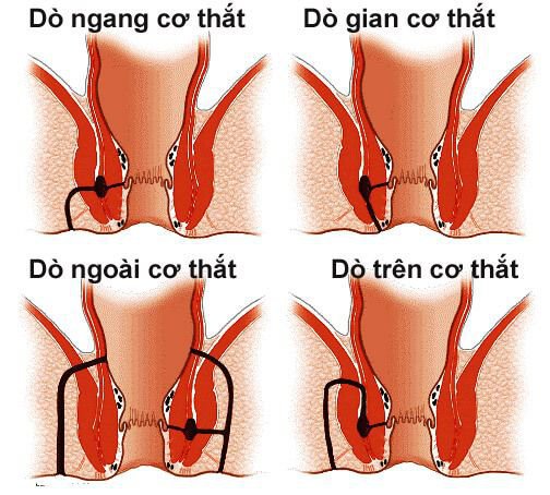 Vai trò của các xét nghiệm hình ảnh đánh giá rò hậu môn Vai trò của các xét nghiệm hình ảnh đánh giá rò hậu môn