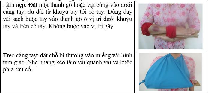 Cố định gãy xương vùng cẳng tay