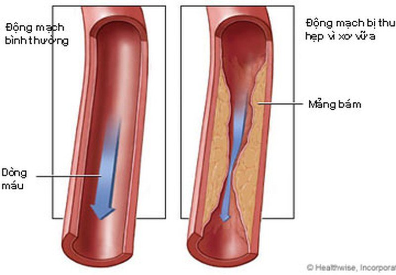 bảo vệ thành mạch máu