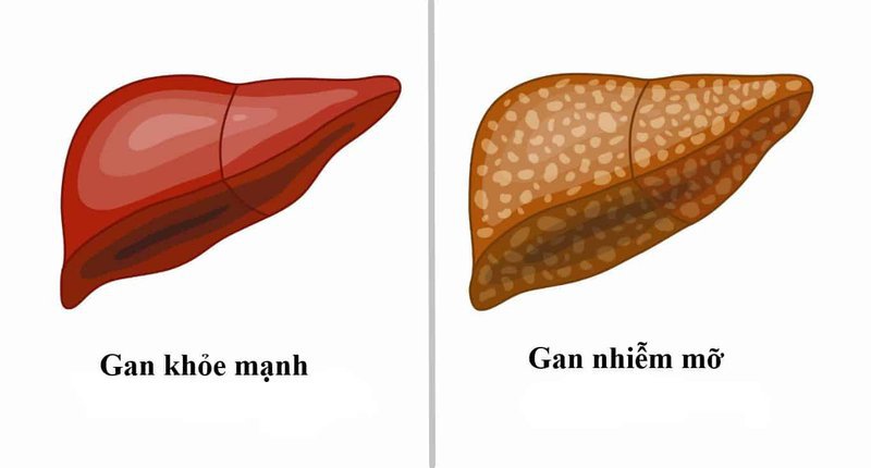 Bị gan nhiễm mỡ cấp độ 1 có sử dụng tinh nghệ được không?