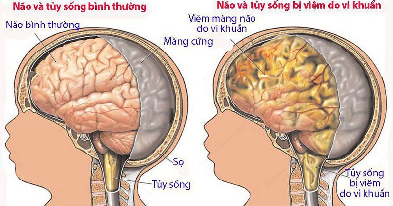 lao màng não có chữa được không