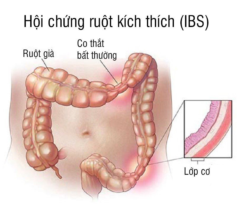 how-to-improve-apple-shaped-irritable-bowel-syndrome-vinmec