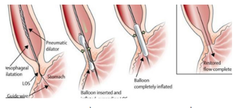 Nội soi thực quản có can thiệp bóng nong