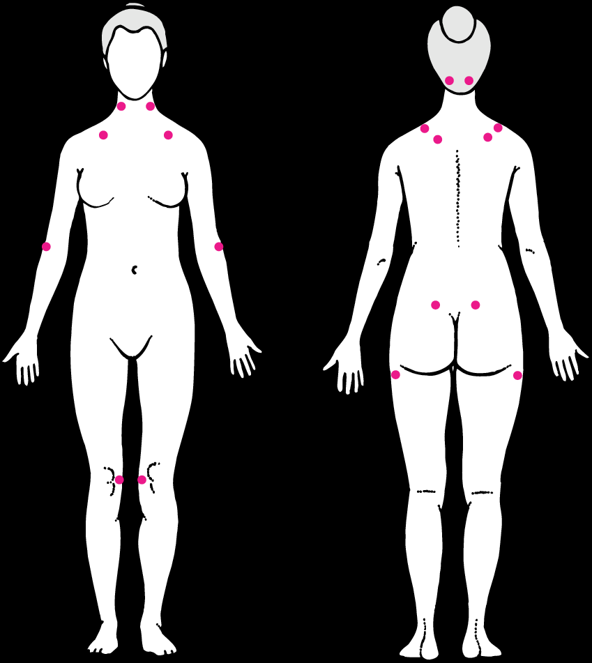 What Is Fibromyalgia Score? | Vinmec