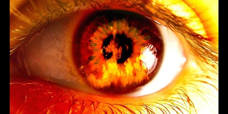 mắt bị bỏng giác mạc có đến 90% là do nhiệt độ gây ra