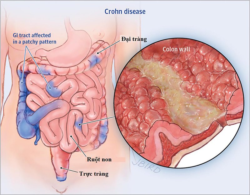 Crohn's Disease vs Lactose Intolerance How to Tell the Difference Vinmec