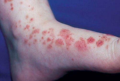 ban xuất huyết dị ứng schonlein
