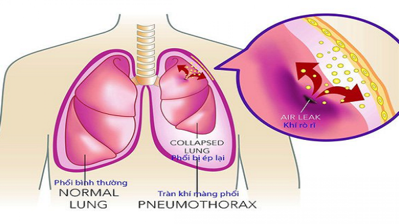 How long to treat pneumothorax? Vinmec