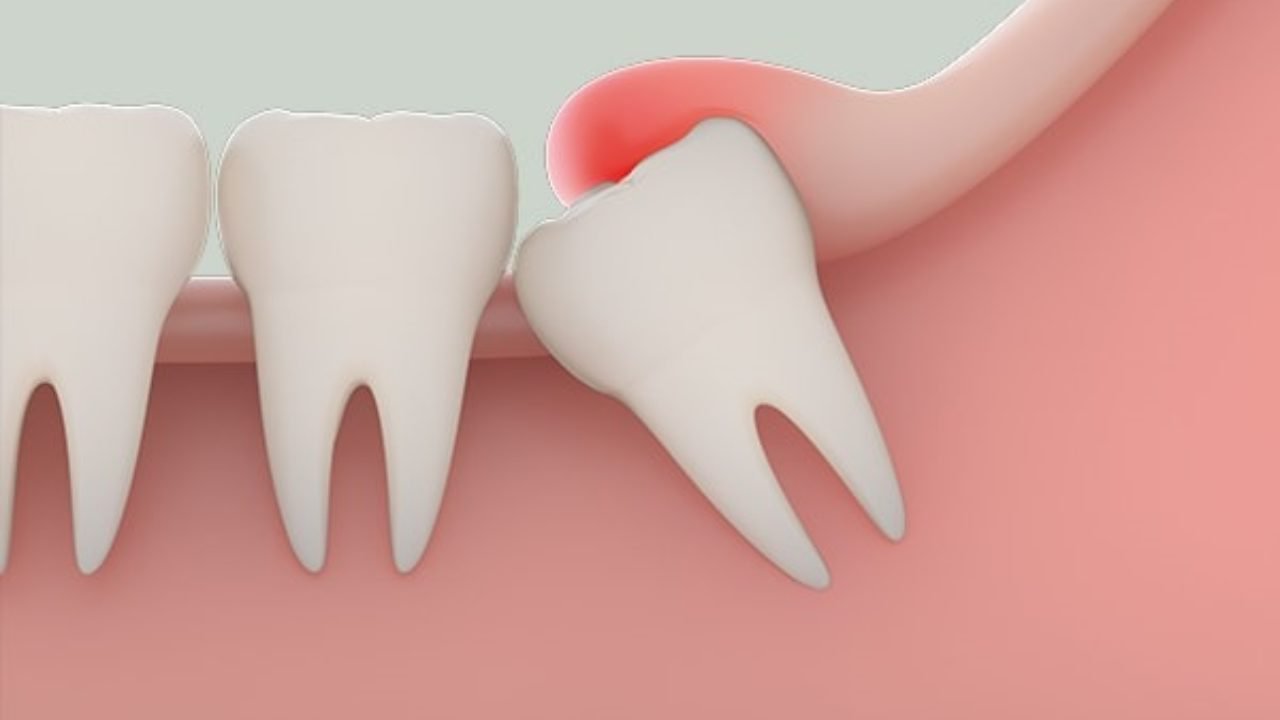 Răng khôn nhưng có vẻ mọc không được khôn lắm