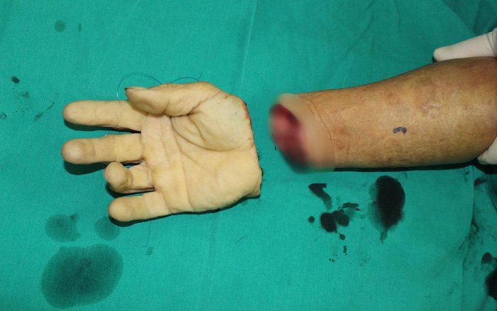 Cách bảo quản chi thể bị đứt lìa