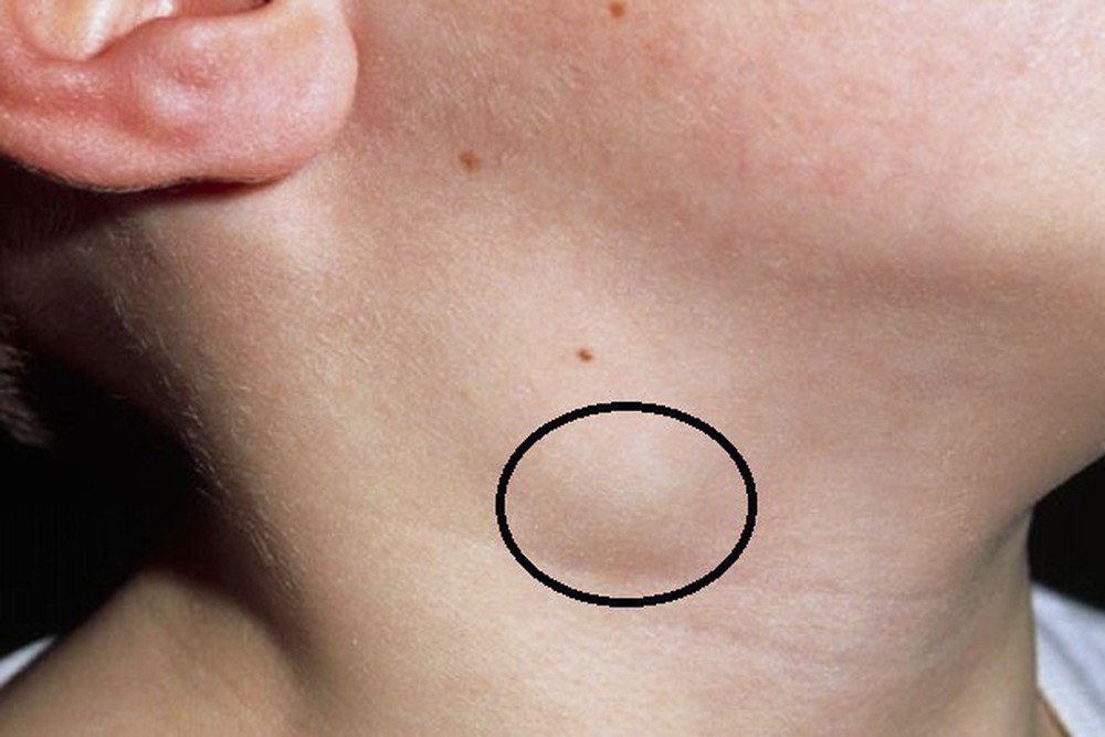 Nguyên nhân viêm nổi hạch cổ Vinmec