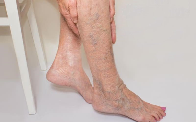 Should you massage when you have varicose veins? Vinmec