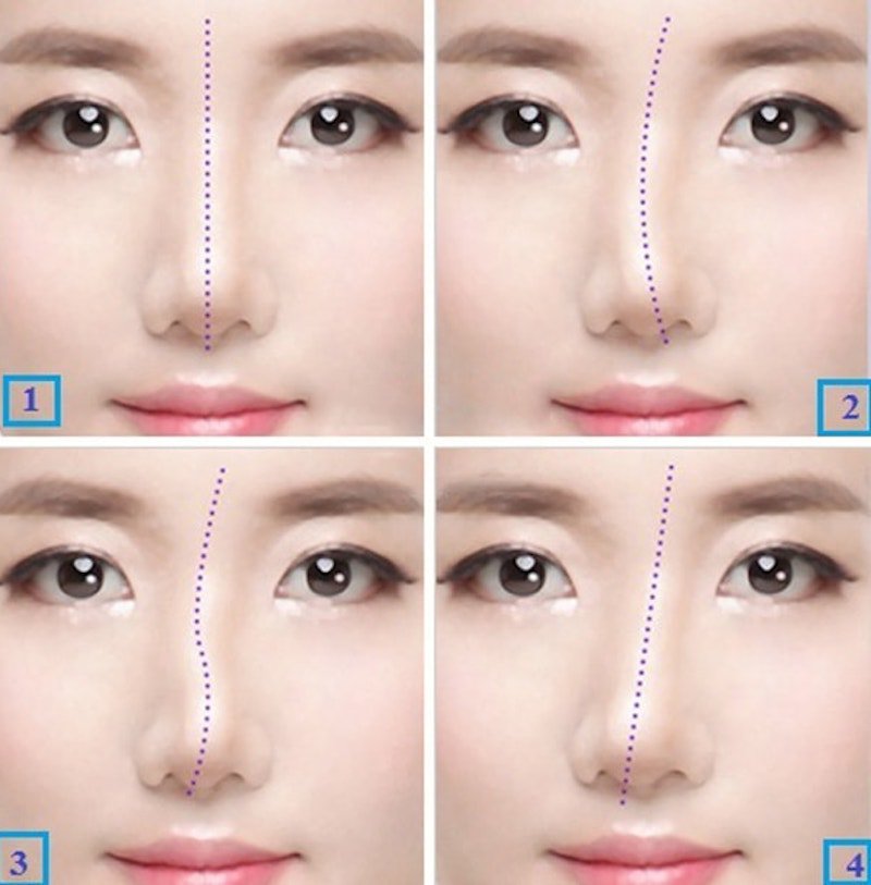 How long after rhinoplasty surgery can be done again? Vinmec