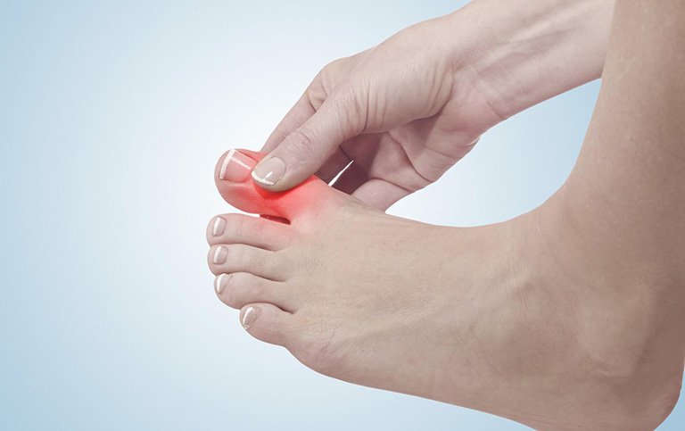 Phác đồ điều trị gout cấp | Vinmec