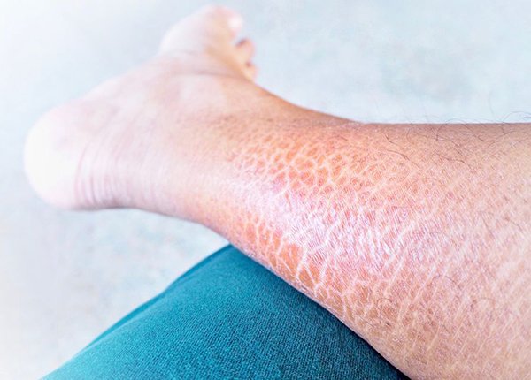 Harlequin ichthyosis (harlequin ichthyosis) | Vinmec