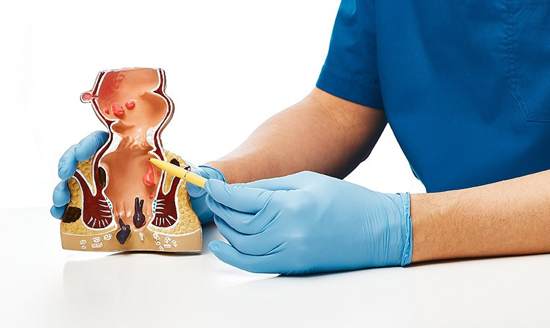 Nên thắt búi trĩ hay cắt trĩ ngoại? | Vinmec