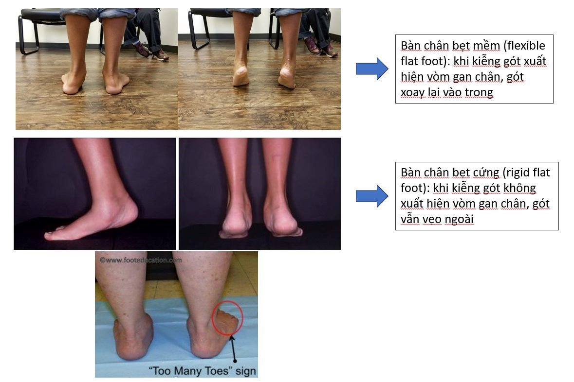 bàn chân bẹt